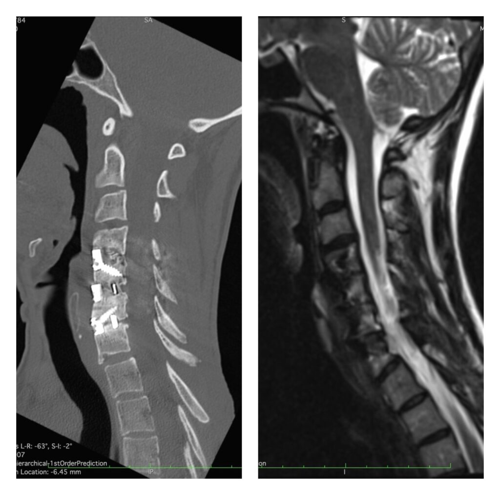 Case Study: Anterior Cervical Discectomy and Fusion | Dr. Salvatore ...